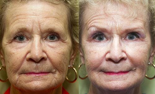 Facial Fillers Before & After Gallery - Patient 58490563 - Image 1