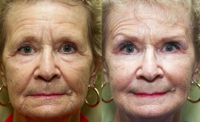 Facial Fillers Before & After Gallery - Patient 58490563 - Image 1