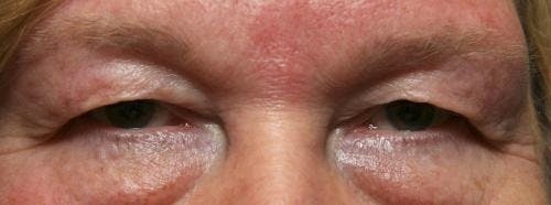 Eyelid Surgery (Upper Blepharoplasty) Before & After Gallery - Patient 58490564 - Image 1