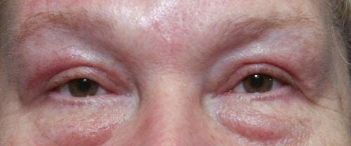 Eyelid Surgery (Upper Blepharoplasty) Before & After Gallery - Patient 58490564 - Image 2