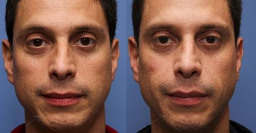 Facial Fillers Before & After Gallery - Patient 58490565 - Image 1