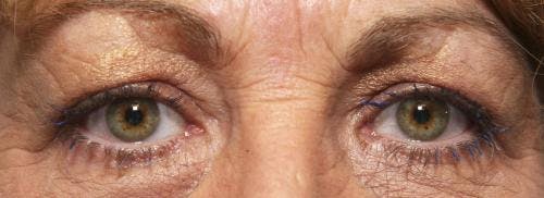 Eyelid Surgery (Upper Blepharoplasty) Before & After Gallery - Patient 58490568 - Image 1