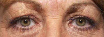 Eyelid Surgery (Upper Blepharoplasty) Before & After Gallery - Patient 58490568 - Image 1