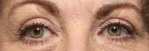 Eyelid Surgery (Blepharoplasty) Before & After Gallery - Patient 58490568 - Image 2