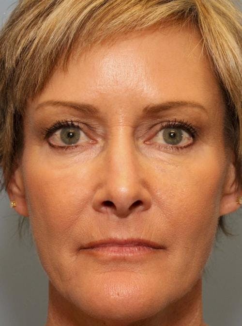 Facial Fillers Before & After Gallery - Patient 58490567 - Image 2