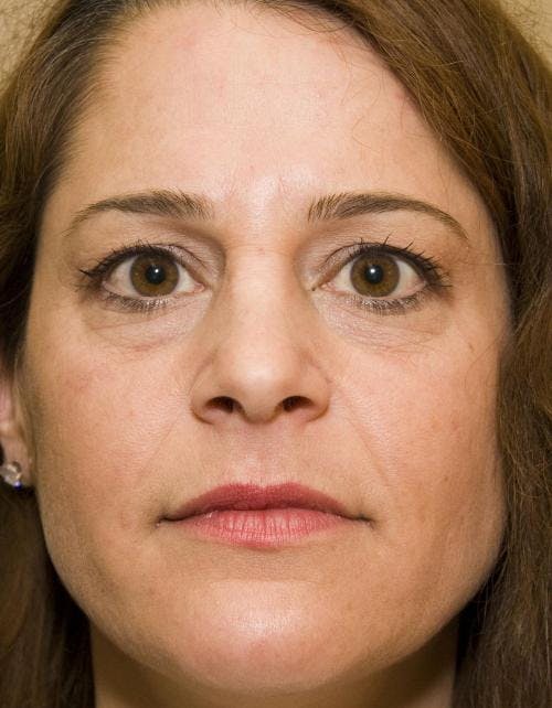 Eyelid Surgery (Blepharoplasty) Before & After Gallery - Patient 58490569 - Image 3