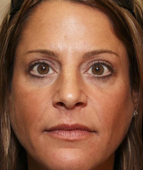 Eyelid Surgery (Upper Blepharoplasty) Before & After Gallery - Patient 58490569 - Image 4
