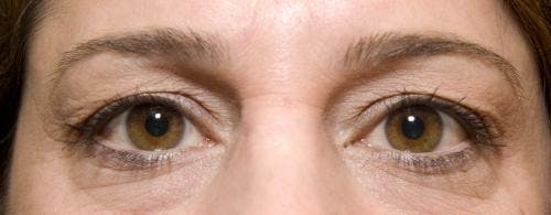 Eyelid Surgery (Blepharoplasty) Before & After Gallery - Patient 58490569 - Image 1