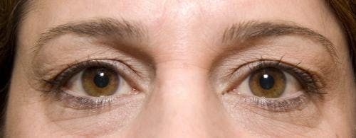 Eyelid Surgery (Upper Blepharoplasty) Before & After Gallery - Patient 58490569 - Image 1