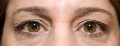 Eyelid Surgery (Upper Blepharoplasty) Before & After Gallery - Patient 58490569 - Image 1