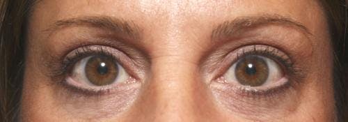 Eyelid Surgery (Upper Blepharoplasty) Before & After Gallery - Patient 58490569 - Image 2
