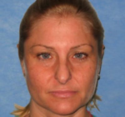 Eyelid Surgery (Upper Blepharoplasty) Before & After Gallery - Patient 58490570 - Image 1