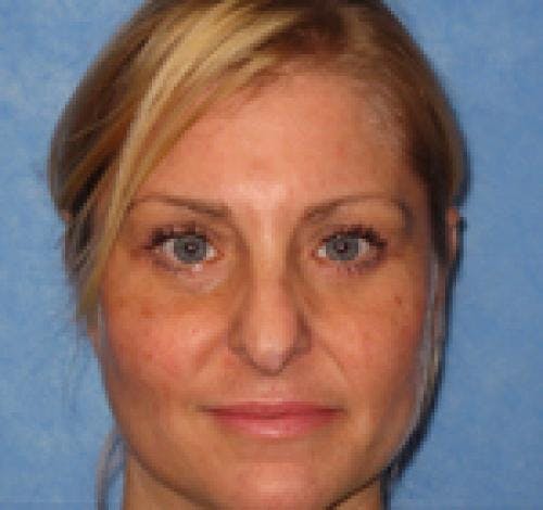 Eyelid Surgery (Upper Blepharoplasty) Before & After Gallery - Patient 58490570 - Image 2