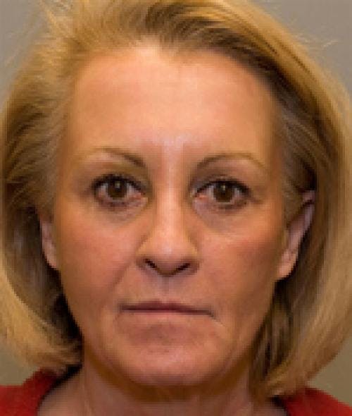 Eyelid Surgery (Upper Blepharoplasty) Before & After Gallery - Patient 58490571 - Image 4