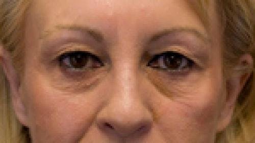 Eyelid Surgery (Blepharoplasty) Before & After Gallery - Patient 58490571 - Image 1