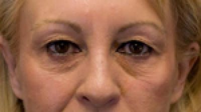 Eyelid Surgery (Upper Blepharoplasty) Before & After Gallery - Patient 58490571 - Image 1