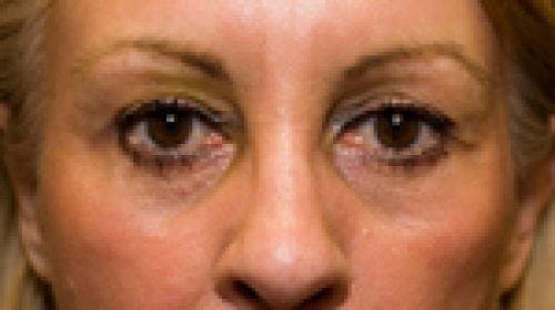 Eyelid Surgery (Blepharoplasty) Before & After Gallery - Patient 58490571 - Image 2