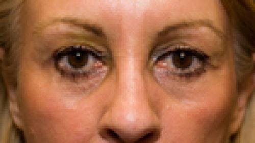 Eyelid Surgery (Upper Blepharoplasty) Before & After Gallery - Patient 58490571 - Image 2