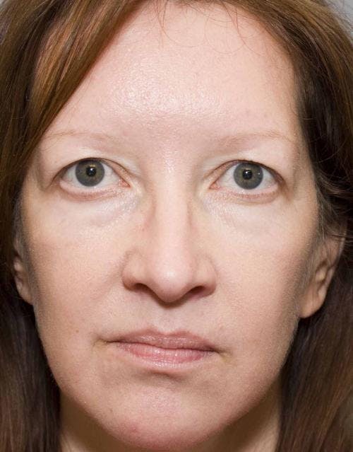 Eyelid Surgery (Blepharoplasty) Before & After Gallery - Patient 58490573 - Image 3
