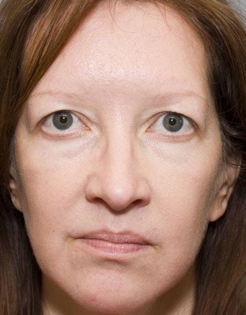 Eyelid Surgery (Upper Blepharoplasty) Before & After Gallery - Patient 58490573 - Image 3