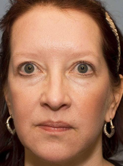 Eyelid Surgery (Upper Blepharoplasty) Before & After Gallery - Patient 58490573 - Image 4