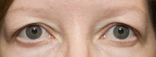 Eyelid Surgery (Blepharoplasty) Before & After Gallery - Patient 58490573 - Image 1