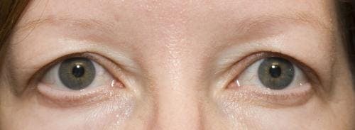 Eyelid Surgery (Upper Blepharoplasty) Before & After Gallery - Patient 58490573 - Image 1