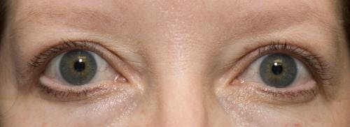 Eyelid Surgery (Blepharoplasty) Before & After Gallery - Patient 58490573 - Image 2