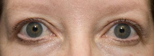 Eyelid Surgery (Upper Blepharoplasty) Before & After Gallery - Patient 58490573 - Image 2