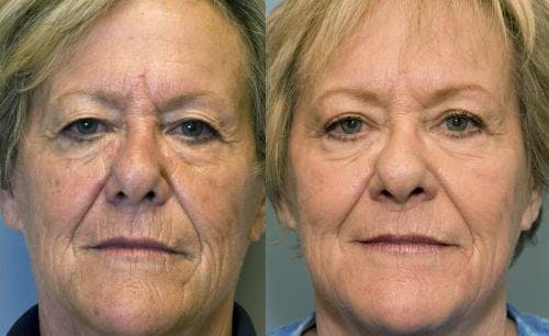 Laser Treatments Before & After Gallery - Patient 58490581 - Image 1