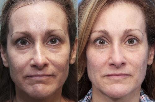 Laser Treatments Before & After Gallery - Patient 58490582 - Image 1