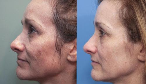 Laser Treatments Before & After Gallery - Patient 58490582 - Image 2