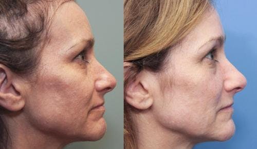 Laser Treatments Before & After Gallery - Patient 58490582 - Image 3