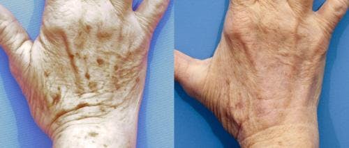 Laser Treatments Gallery - Patient 58490583 - Image 1