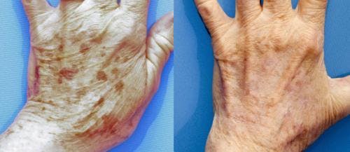Laser Treatments Before & After Gallery - Patient 58490583 - Image 2