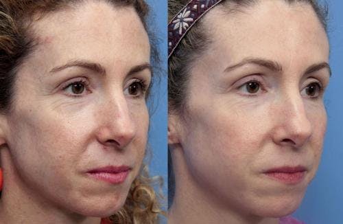 Laser Treatments Before & After Gallery - Patient 58490584 - Image 1