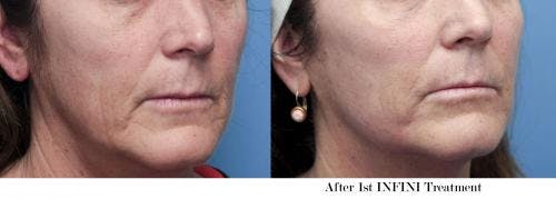 Infini Before & After Gallery - Patient 58490585 - Image 1