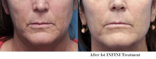 Infini Before & After Gallery - Patient 58490585 - Image 2