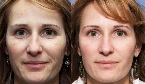 Laser Treatments Before & After Gallery - Patient 58490586 - Image 1