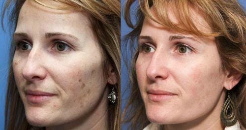 Laser Treatments Before & After Gallery - Patient 58490586 - Image 2