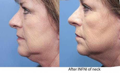 Infini Before & After Gallery - Patient 58490587 - Image 1