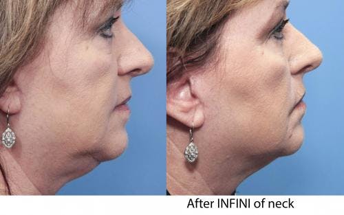 Infini Before & After Gallery - Patient 58490587 - Image 2