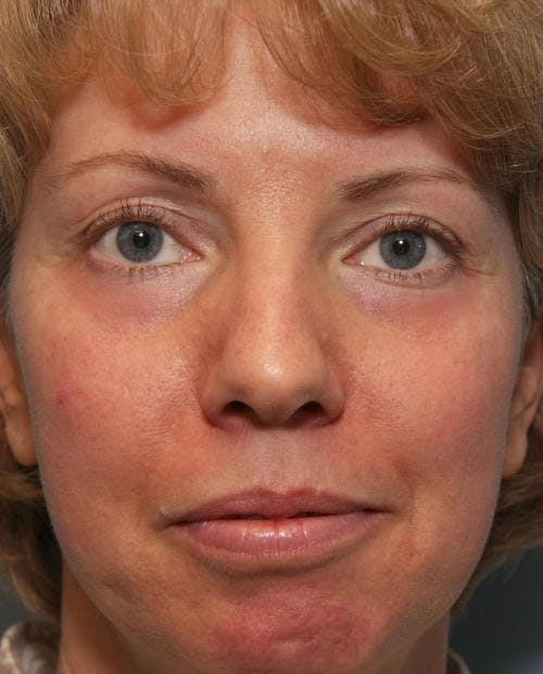 Laser Treatments Before & After Gallery - Patient 58490589 - Image 2