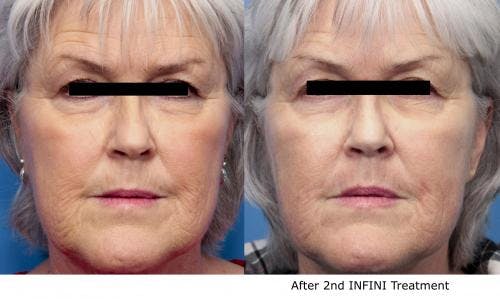Infini Before & After Gallery - Patient 58490588 - Image 1