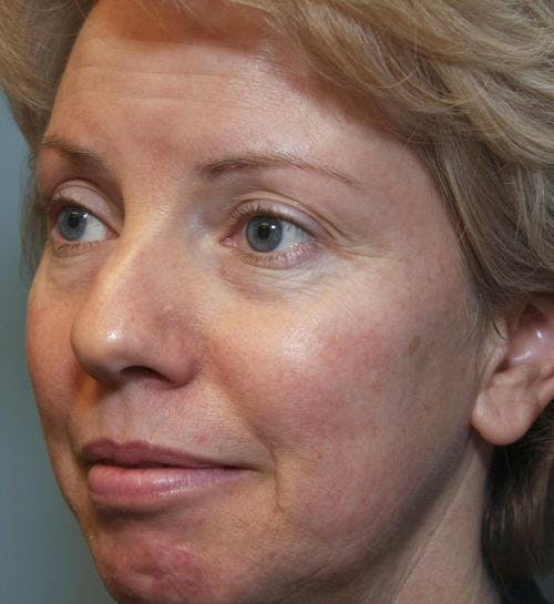 Laser Treatments Before & After Gallery - Patient 58490589 - Image 3