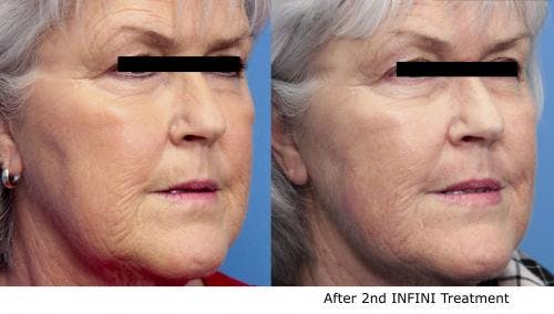 Infini Before & After Gallery - Patient 58490588 - Image 2