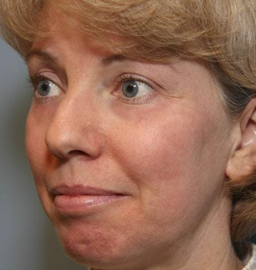 Laser Treatments Before & After Gallery - Patient 58490589 - Image 4