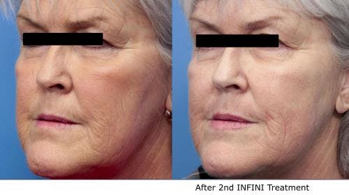 Infini Before & After Gallery - Patient 58490588 - Image 3