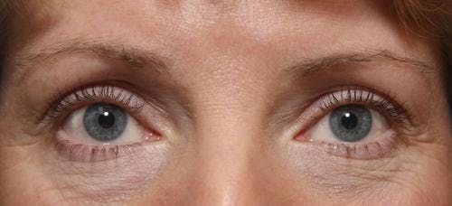 Laser Treatments Before & After Gallery - Patient 58490589 - Image 5