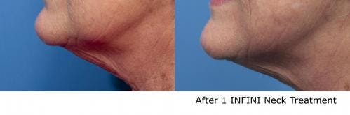 Infini Before & After Gallery - Patient 58490588 - Image 4